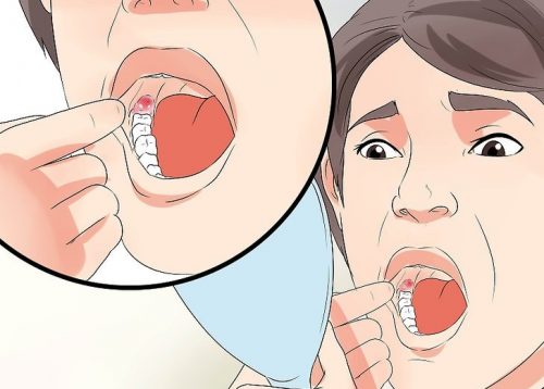 How to Reduce Swelling After Wisdom Teeth Removal