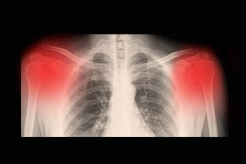 What is Osteoarthritis? Everything You Need to Know What is Osteoarthritis? Everything You Need to Know