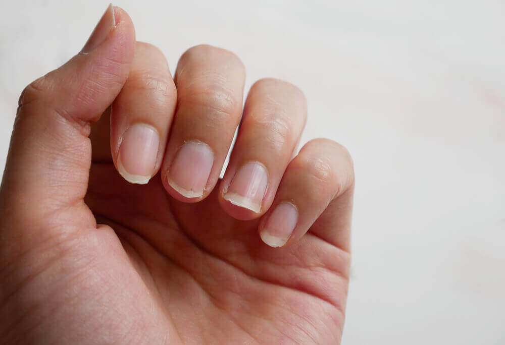 A hand with broken nails and small lunulae.