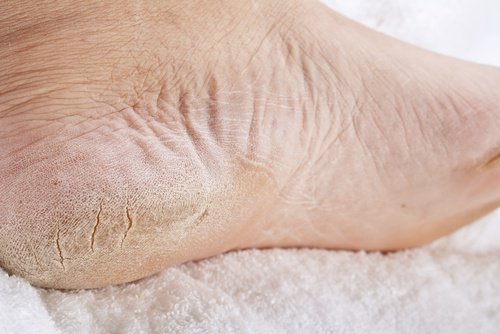 A home remedy to treat foot fungus and calluses.