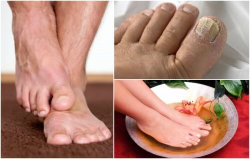 Do You Have Symptoms of Foot Fungus?