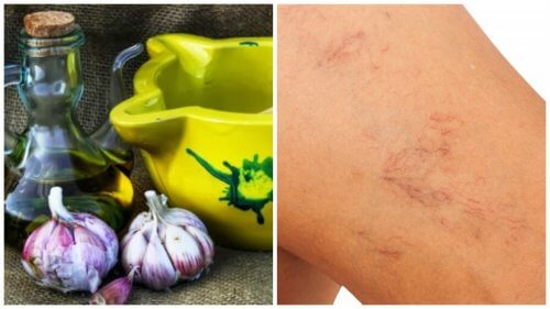 Treat Varicose Veins Naturally With Olive Oil and Garlic