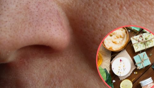 8 Homemade Remedies to Shrink Large Pores 8 Homemade Remedies to Shrink Large Pores