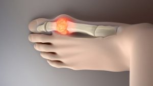 Try These 8 Ideal Foods to Lower Uric Acid Levels