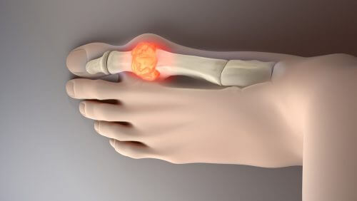 Try These 8 Ideal Foods to Lower Uric Acid Levels