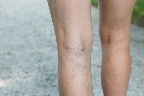 use olive oil and garlic to treat varicose veins naturally