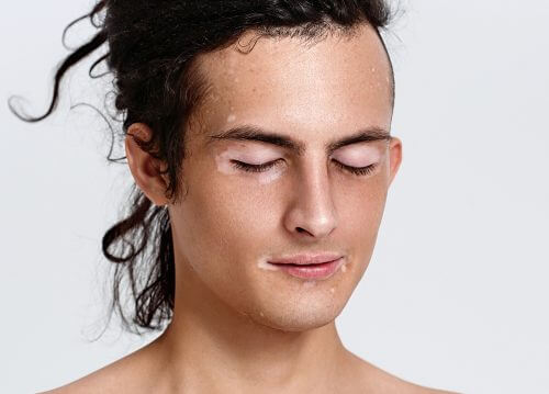 Woman with vitiligo