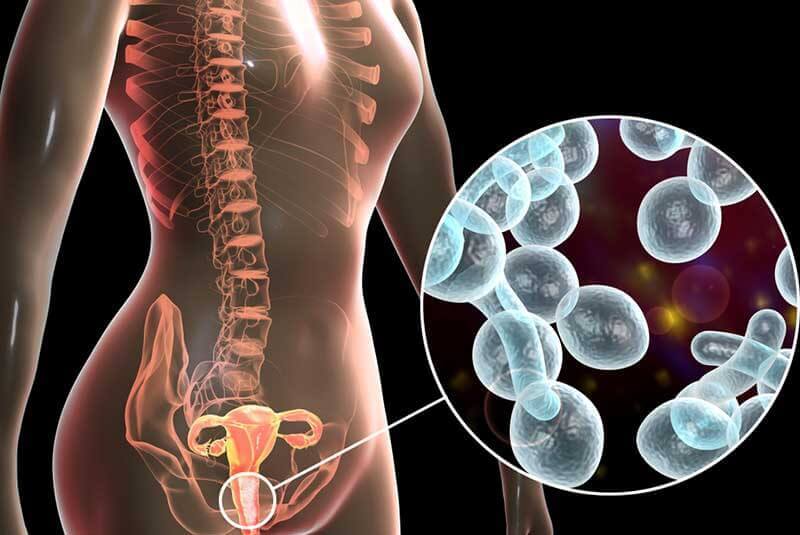 Symptoms fo vulvitis: a digital image of a yeast infection.