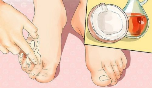 Bunions and Corns: Four Natural Remedies