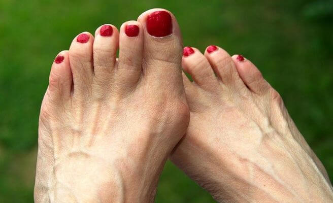 Feet with bunions and corns