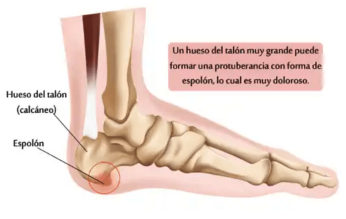 Can You Cure a Heel Spur Naturally?
