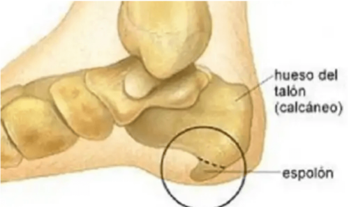 A diagram of a heel spur.
