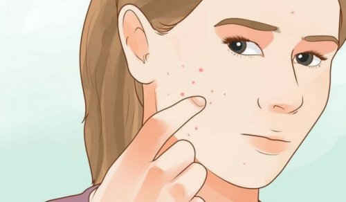 Acne is one of the symptoms of hormonal imbalance