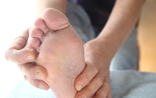 Remedy for athlete's foot