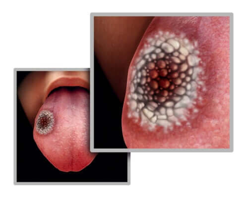 Five Possible Symptoms of Tongue Cancer
