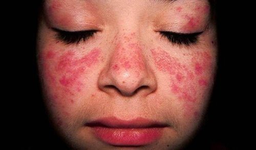 The Treatment for Systematic Lupus Erythematosus (SLE)