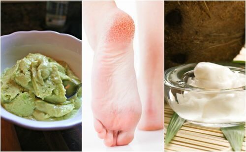 Do You Have Cracked Heels? Try These 5 Home Remedies Do You Have Cracked Heels? Try These 5 Home Remedies
