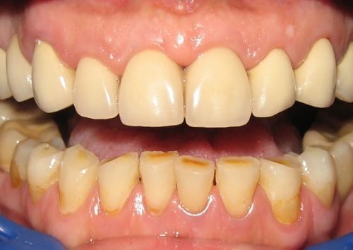 10 Natural Methods to Get Rid of Dental Plaque