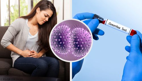 Gonorrhea Prevention and Treatment Facts to Know