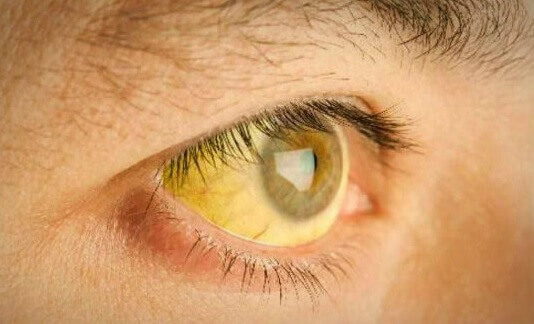 A person with yellow eyes because of an overload of toxins in the liver.