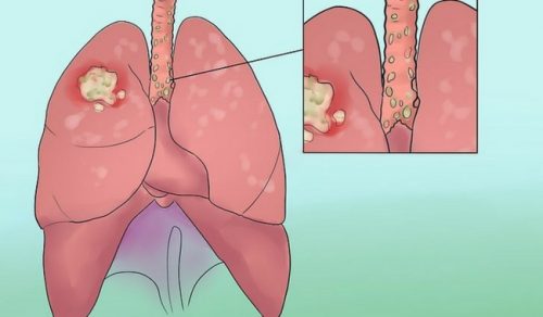 8 Shocking Signs of Lung Cancer You Shouldn't Ignore