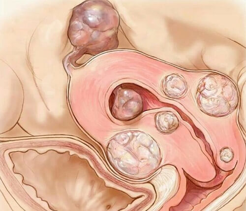 Uterine fibroids
