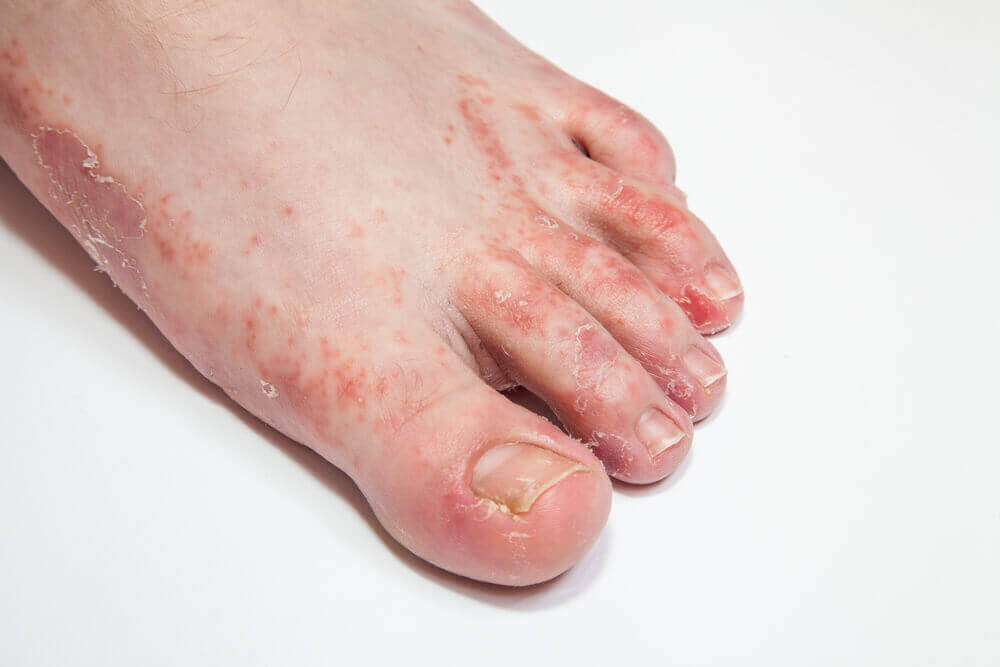 A person with athlete's foot.