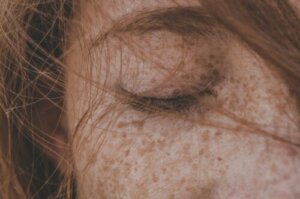 Is it Possible to Remove Freckles Naturally?