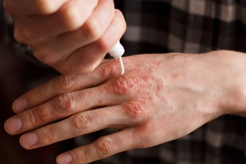 Natural Creams to Treat Psoriasis: Try These Recipes!