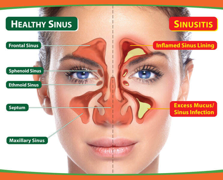 Sinusitis Symptoms: From Origin to Diagnosis