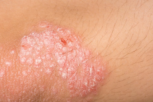 Tarmproblem kan ge dålig hud