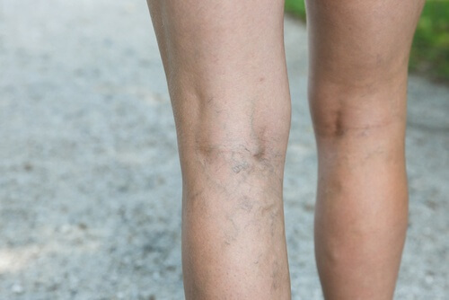 Treat varicose veins