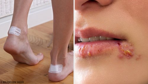 5 Ways to Heal and Eliminate Blisters