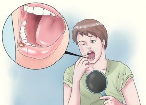 8 Natural Remedies that May Help Treat Canker Sores
