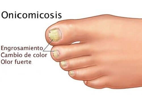 A diagram of nail fungus.