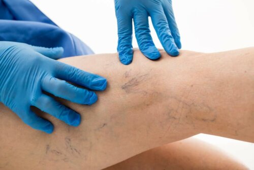 A specialist examining some varicose veins.