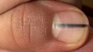 A Black Line on Your Nails Could Be a Sign of Cancer