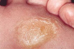 5 Natural Remedies for Softening Calluses