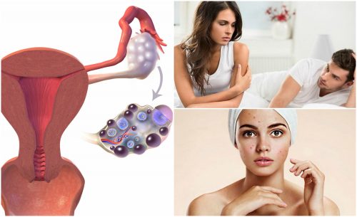 7 Symptoms of Polycystic Ovarian Syndrome that You Shouldn’t Ignore 7 Symptoms of Polycystic Ovarian Syndrome that You Shouldn’t Ignore