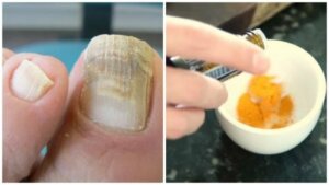 A Natural Turmeric Remedy Against Nail Fungus