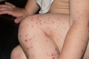 Coxsackievirus: How it Affects Adults and Preventive Measures