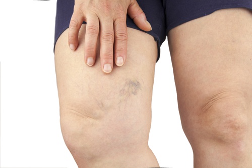 Why is fluid retention produced