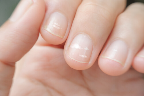 A woman with fingernail ridges.
