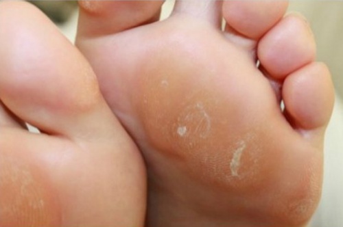 4 Home Remedies to Treat Calluses