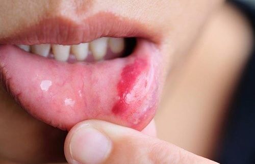 Mouth Cancer: Symptoms and Risk Factors