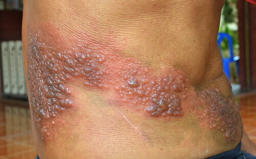 shingles symptoms