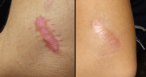 How To Treat Keloid Scars Naturally
