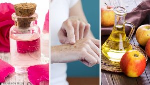 Eight Natural Ways to Lighten Age Spots on Your Hands