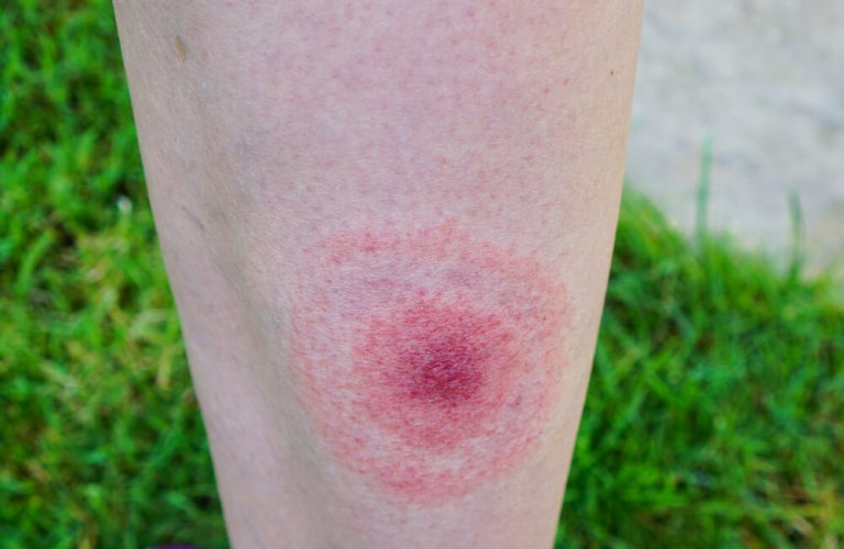 Lyme Disease Symptoms You Need to Know Step To Health