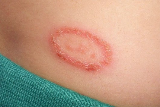 Home Remedies to Treat Ringworm 